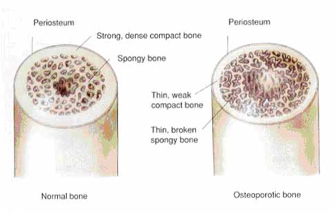 cross section of normal bone and osteoporotic bone