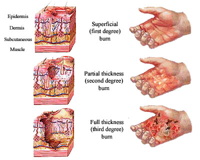 burn classification