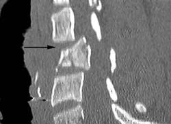 CT scan of fractured vertebra
