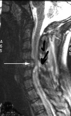 spinal cord being compressed by fractured vertabra