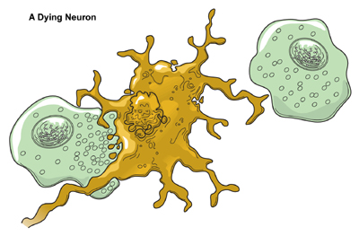 picture of a dying neuron