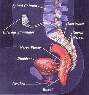 diagram showing placement of the VOCARE Bladder System